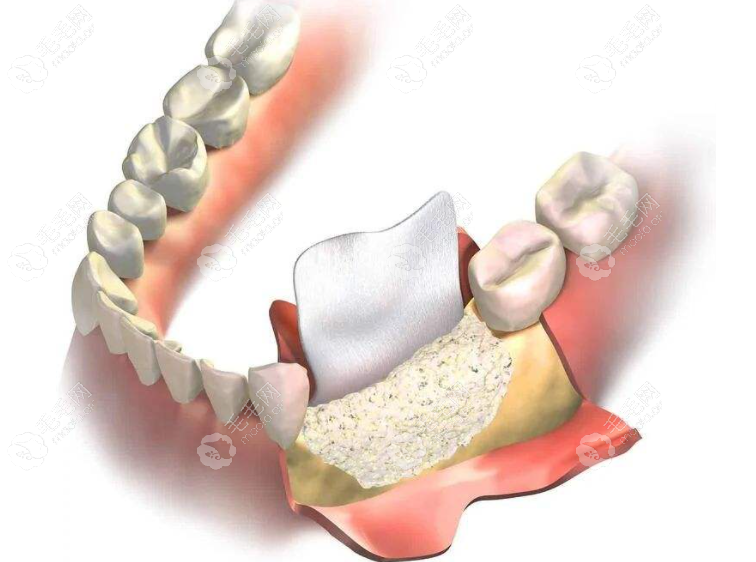 植骨粉骨膜几个月后可做种植牙呢,听说植骨7-10天后就消肿啦
