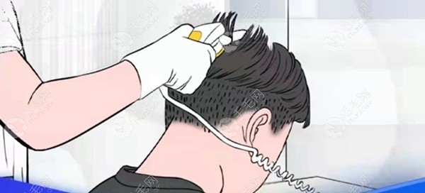 正规的毛囊检测是怎么进行的