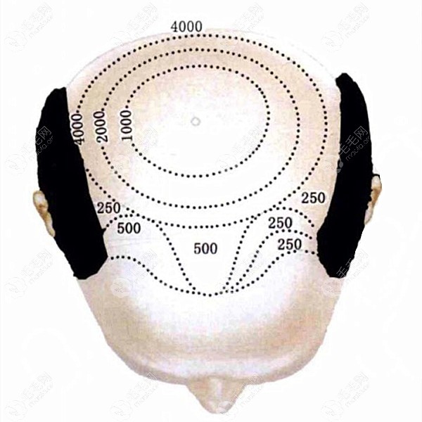植发500单位多大面积需要植发多少毛囊，看图