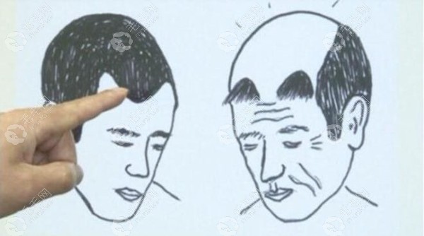 植发后变小龙人长这样