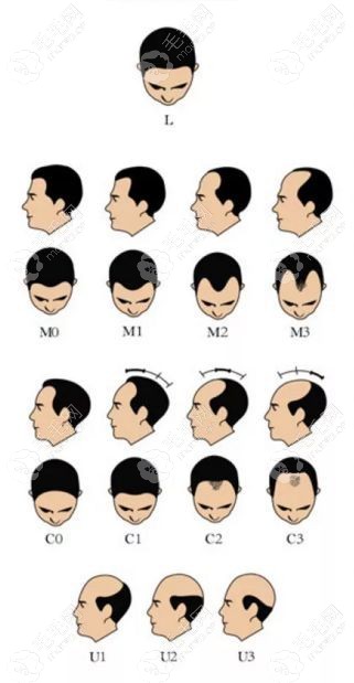 L型脱发、M型脱发、C型脱发、U型脱发雄脱4种基本型