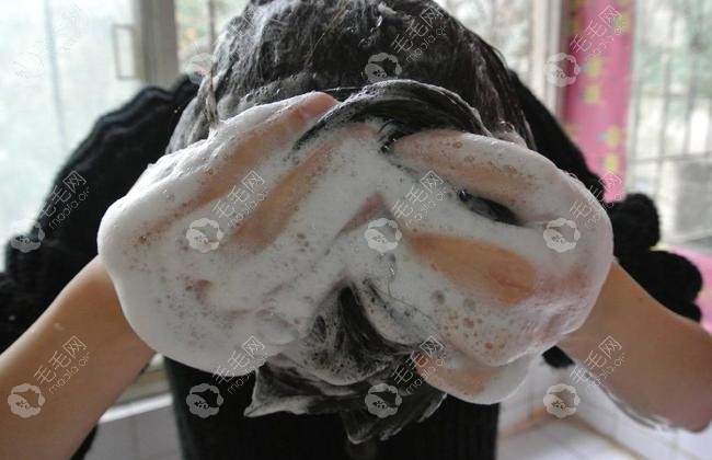 硫磺皂洗头发对治疗脱发有用吗