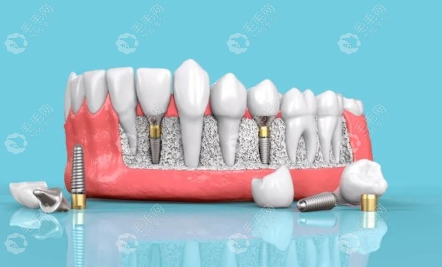 种植牙被誉为人类的第三副牙齿