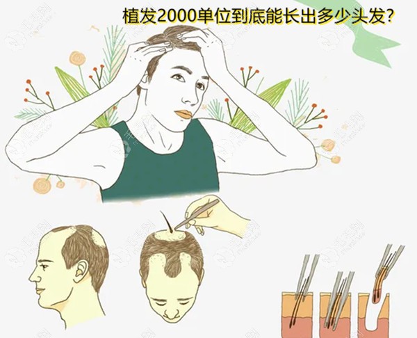 植发2000单位是多少根头发，种植2000单位头发需要多长时间