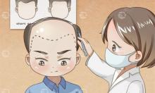植发日记：让你了解我做秃顶植发手术的过程具体是怎样的