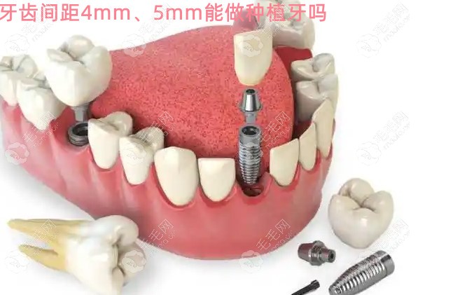 牙齿间距4mm或5mm可以做种植牙吗
