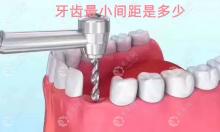 牙齿间距4mm/5mm可以做种植牙吗？说下种植牙最小间距是多少