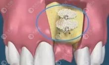 种植牙骨粉有哪些品牌?牙骨粉国产和进口区别大吗？