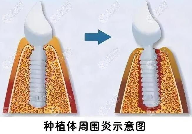 牙周炎容易导致植体周围炎