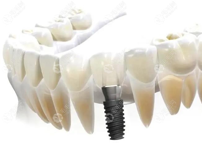 在做种植牙之前需要先治疗牙周炎,否则可能导致种牙失败