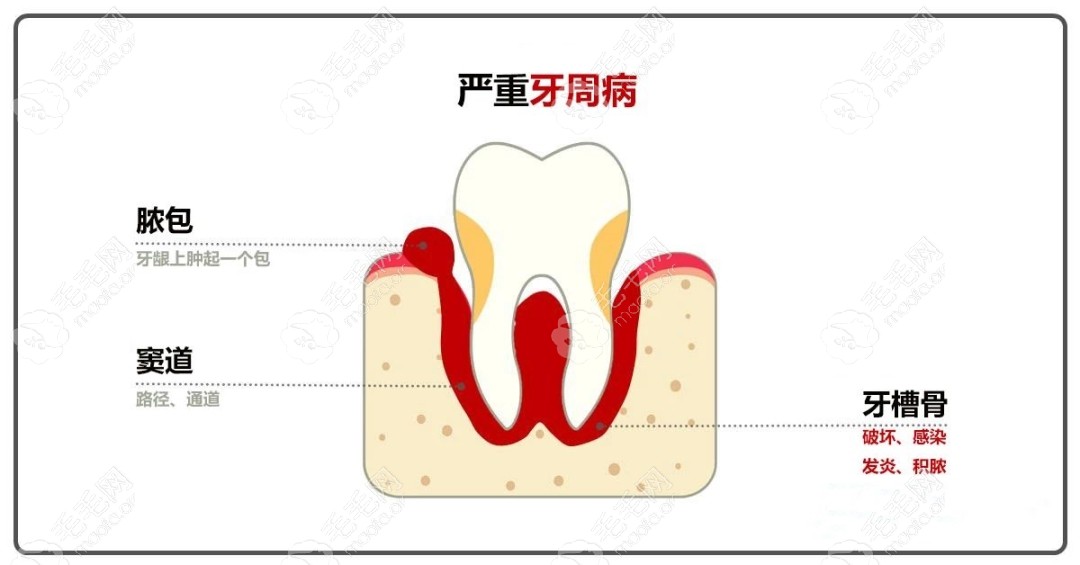牙龈脓包的样子