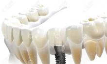 在做种植牙之前需要先治疗牙周炎,否则可能导致种牙失败
