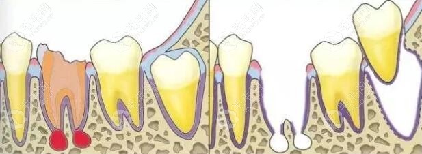 自体牙移植后使用寿命能保持多久