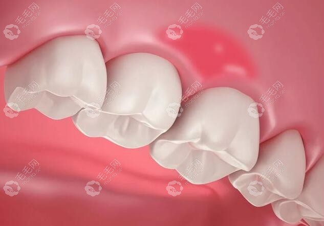 全口牙周治疗的收费标准包含有:龈下刮治/膜龈手术等费用