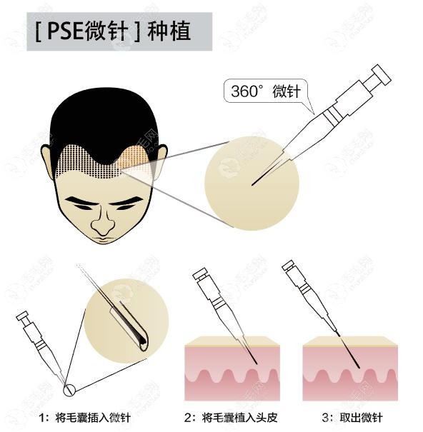 四种植发技术之微针植发