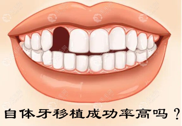 自体牙移植成功率在95%左右,那自体牙移植后使用寿命是多久