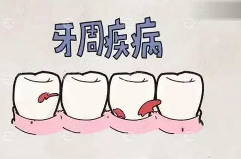 老年人重度牙周炎导致牙槽骨萎缩厉害