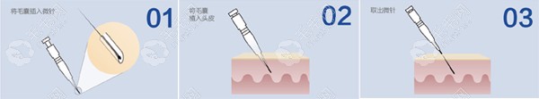 大麦微针植发技术手术流程展示