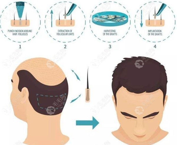bht植发技术可以降低毛囊损伤