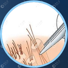 BHT是碧莲盛专门研发的一项更精细的毛囊移植术