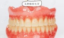 无种植仿生牙和活动义齿及种植牙有什么区别,不都是假牙嘛