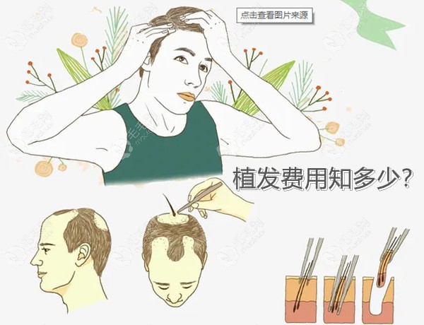 上海植发多少钱一个毛囊，排名前三的植发机构价格表公布