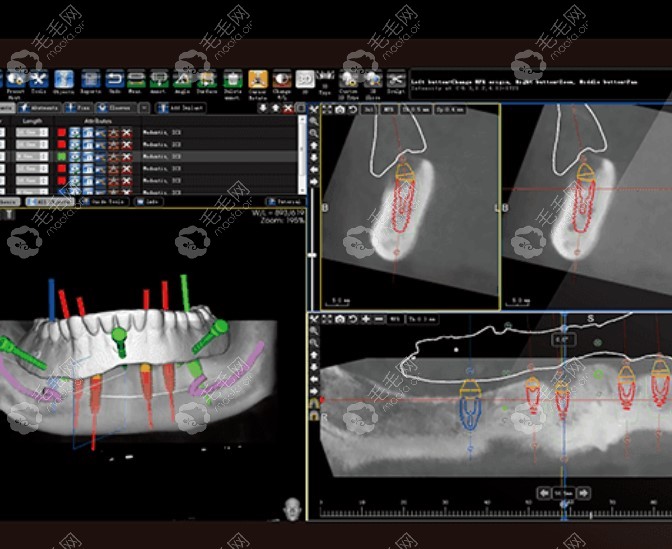 数字化设备模拟出种植牙过程