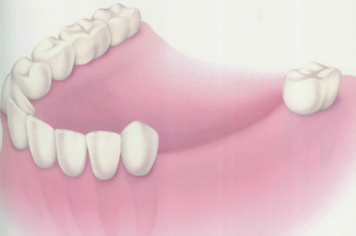 种植牙安装牙冠过程动图