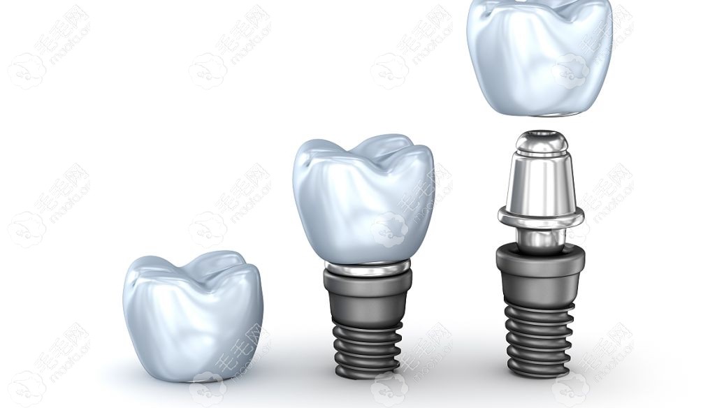 连着种三颗牙齿要几个种植体?如果缺三颗牙种2颗有啥优缺点