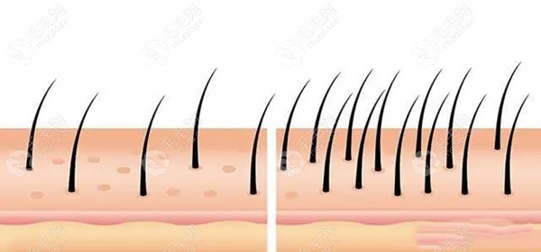 植发为什么达不到原生发密度,是因为加密伤害了原生发吗？