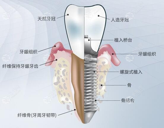 牙槽骨量不足用德国生长因子种植牙技术，可减少植骨哦