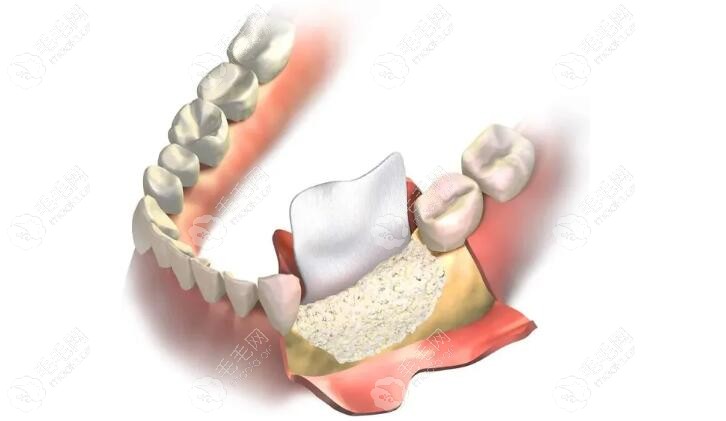 牙槽骨骨质疏松怎么办