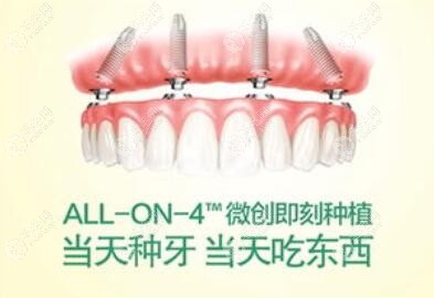 allon4/6即刻负重种植牙是什么意思?据说适合做半全口种植