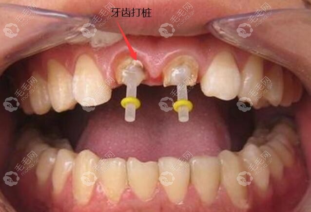 根管治疗牙齿打桩和种植牙的区别