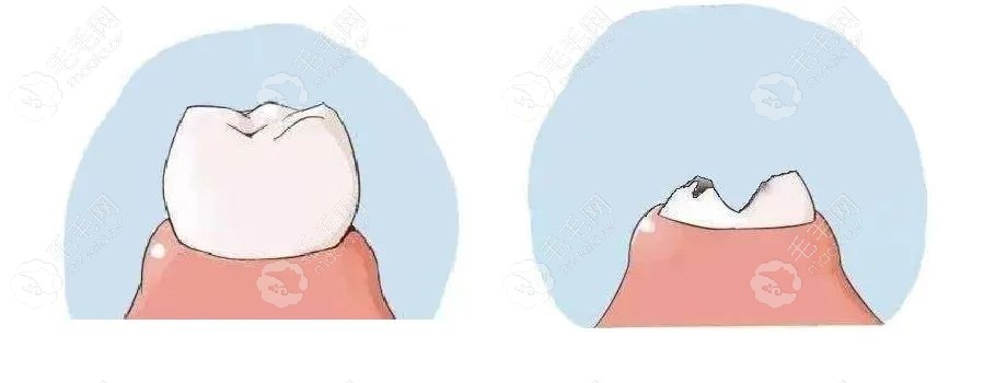 牙残根指的是牙冠部分已经大量缺失