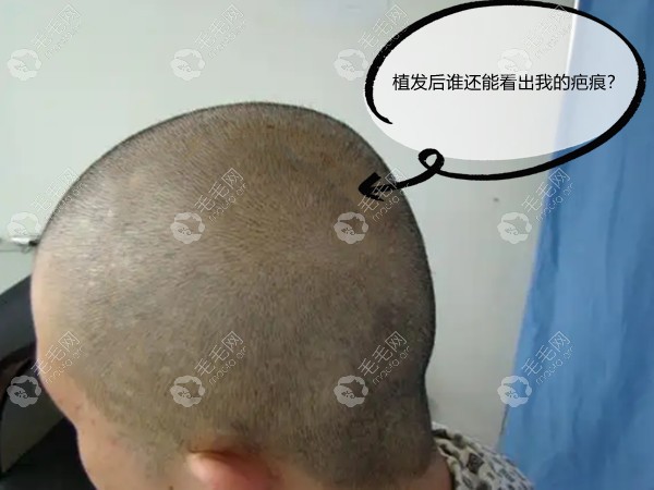 开颅手术后疤痕上可以植发吗术后多久可以植发