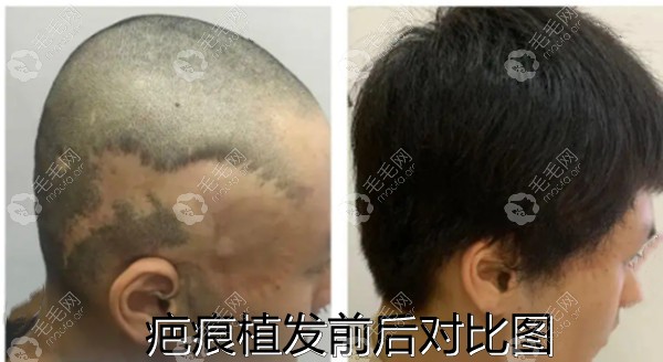 疤痕植发前后对比图