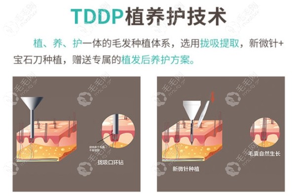 新生植发TDDP技术优势