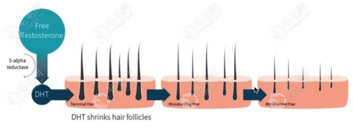 雄激素脱发受DHT的影响