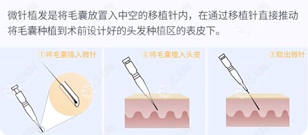 广州荔湾区人民医院植发科普通微针植发优惠价格是4.8元起一个单位