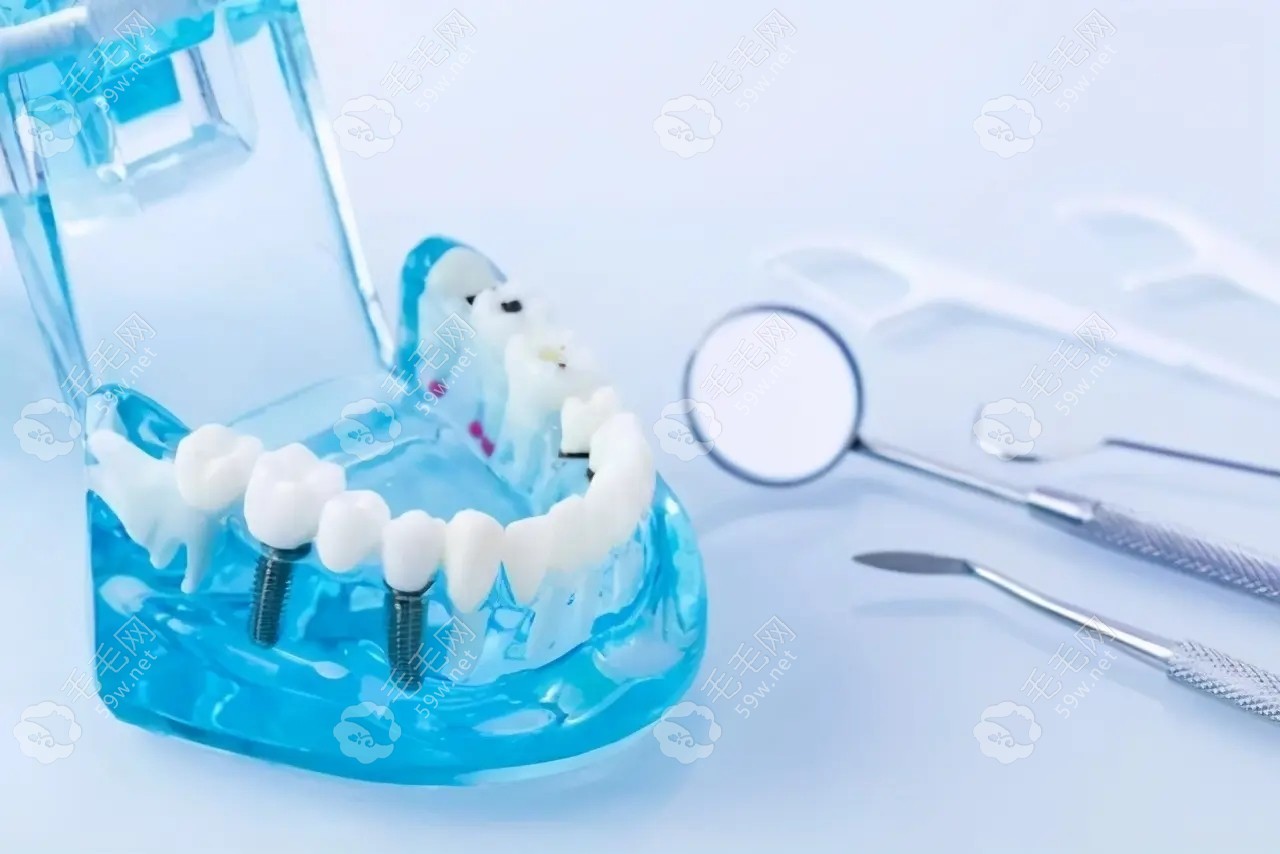 2022正规医院镶牙收费标准:目前种牙/烤瓷牙等假牙价格表是..