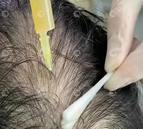 头皮注射一次cgf的价格