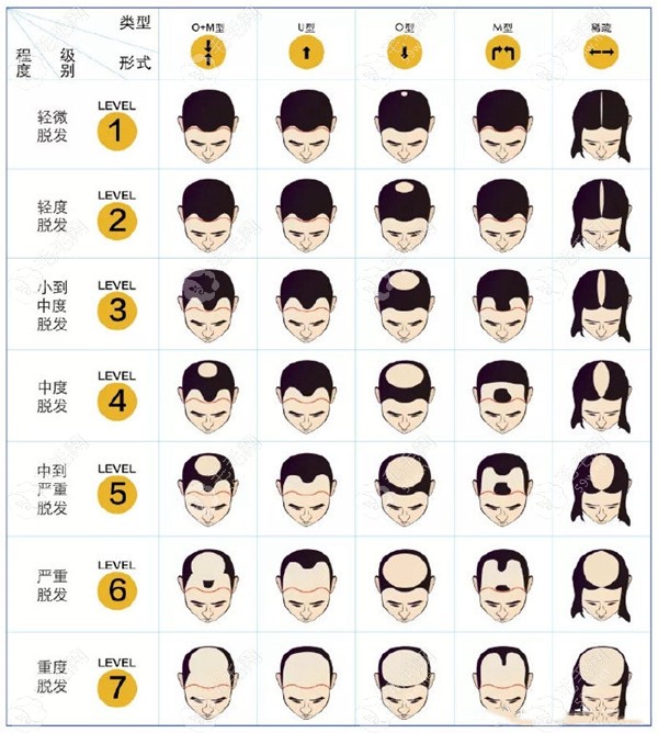 三四级脱发属于晚期了吗?这三级脱发可以恢复的办法有.