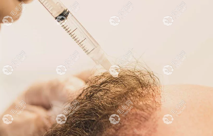 中胚疗法对于头发发量少改善比较有效