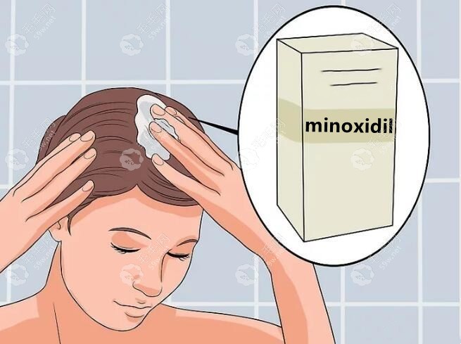 植发后做护理涂在头皮的是什么药?是米诺地尔或营养剂吗