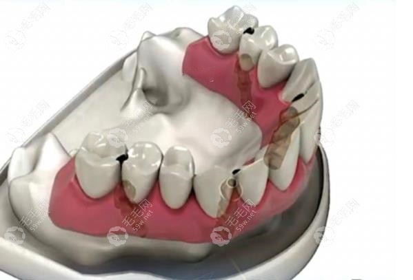 半固定种植牙也叫种植覆盖义齿