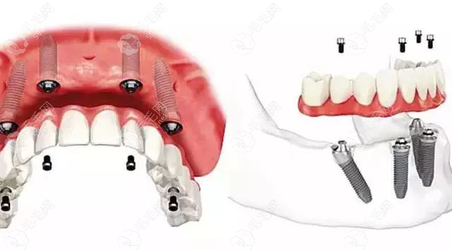 种植牙的牙冠上有洞是为了便于螺丝的固定
