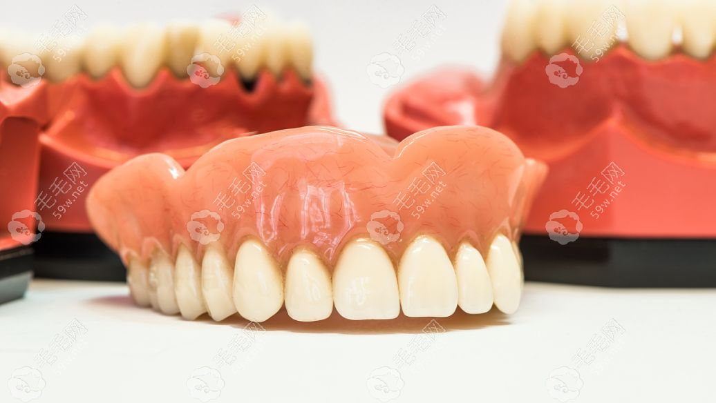 假牙种类