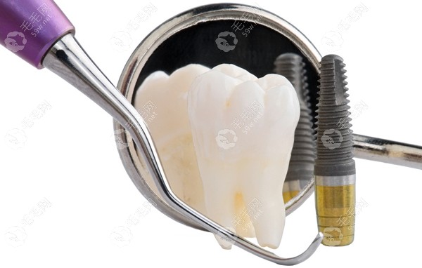 瑞士士卓曼种植牙多少钱一颗?提供ITI-Roxolid和SLActive型号价格