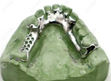 钛合金支架义齿的样子